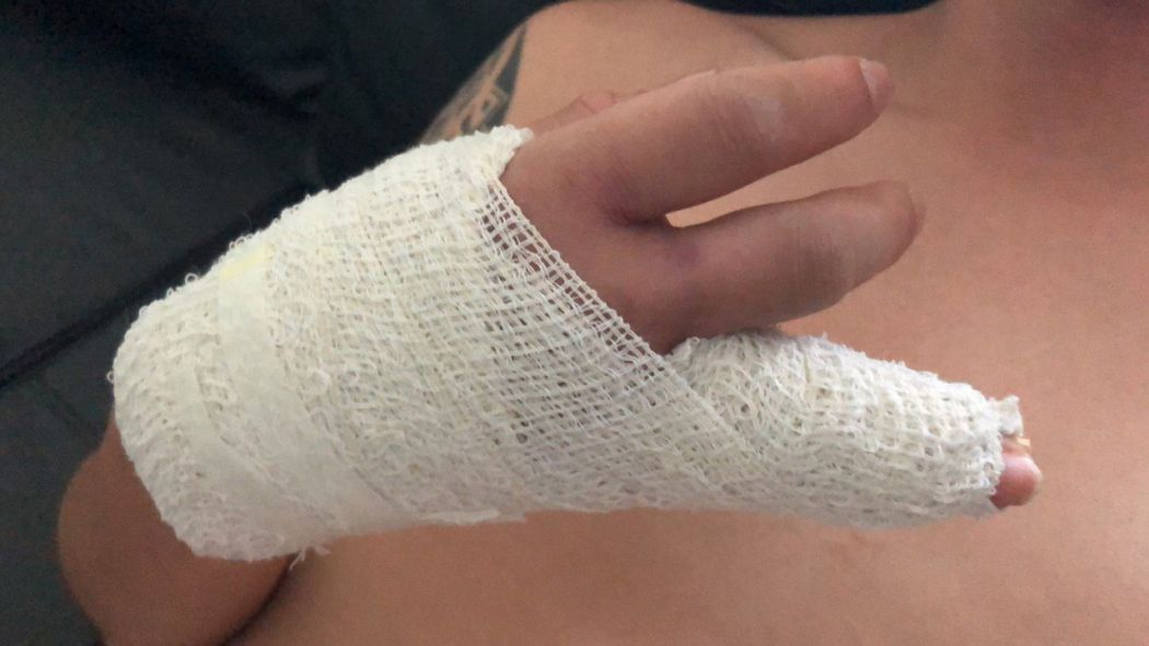 Broken ring finger Hong Kong protester rubber bullet underground hidden clinic